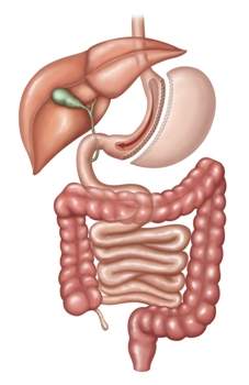 Sleeve Gastrectomy